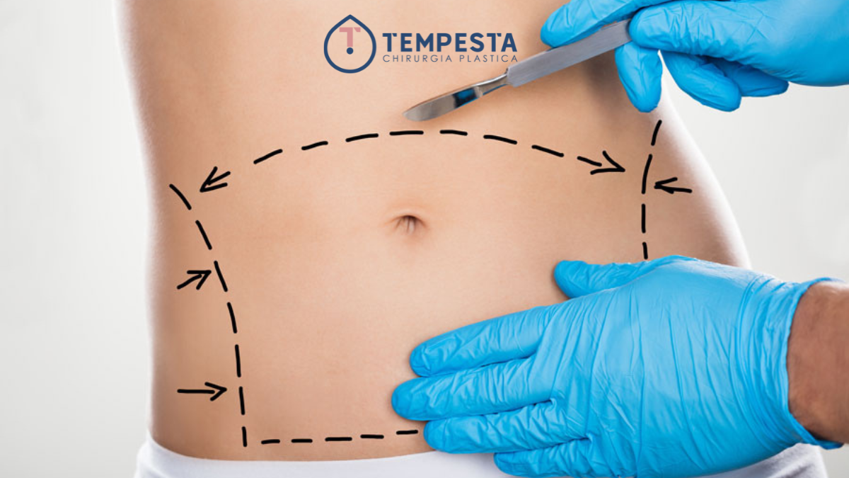 L’Addominoplastica permette di correggere un addome prominente dovuto a problematiche come rilassamento della parete addominale, diastasi dei muscoli retti, gravidanze e dimagramenti. E’ opportuno specificare che l’addominolpastica non serve a perdere peso, ma consente di eseguire una plastica dei muscoli retti, che vengono rinforzati lungo la linea mediana e gli obliqui, con il risultato di ottenere una riduzione del punto vita. Inoltre la cute e il tessuto adiposo in eccesso vengono asportati, migliorando l’aspetto dell’addome.